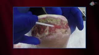 WCW: Follow Up - Removing Necrotic Tissue to Promote Healing