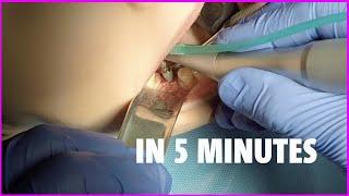 Dental Implant Placement UNDER 5 MIN