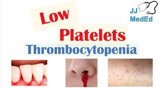 Thrombocytopenia | Signs and Symptoms and Approach to Causes