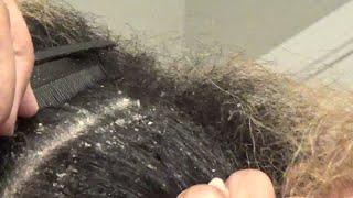 Dandruff Scratching | Itchy Dry Scalp