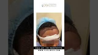 Female Hair Transplant | Hair Transplant in Vizag | Dr. VJs Cosmetic Surgery & Hair Transplantation