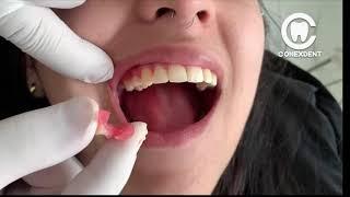 Dental prosthesis  flexible economic 