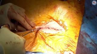 Transcatheter aortic valve replacement (TAVR) using the transaortic (TAo) approach