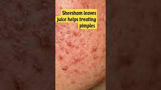 Sheesham leaves juice helps treating pimples #ayurveda #health #ayurvedictreatment #herbs #acne