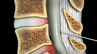 Epidural Steroid Injections