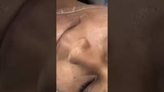 Dermapen treatment