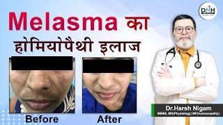 Melasma का होमियोपैथी इलाज