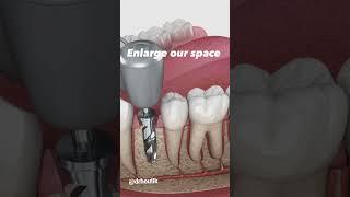 Tooth Implant Procedure. Process: Step by Step