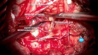 Клипирование аневризмы позвоночной артерии после разрыва. Нейрохирург Царикаев А.В.