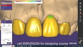 Exocad Video Tutorial/How to Design in EXOCAD? Anterior Teeth/in hindi