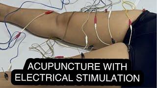 Acupuncture With Electrical Stimulation