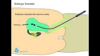 Embryo Transfer procedure