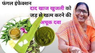 दाद खाज खुजली को जड़ से खत्म करेगा यह घरेलू नुस्खा | Daad khaj khujli home remedy