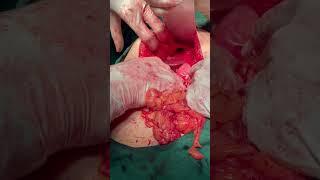 A hole in diaphragm        Diaphragmatic hernia ‍️