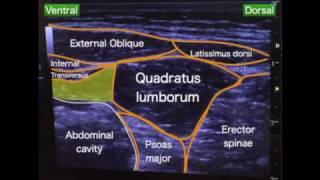 Quadratus lumborum block intramuscular approach