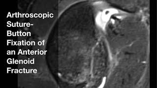 Arthroscopic Suture Button Fixation of an Anterior Glenoid Fracture