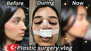i got a rhinoplasty in TURKEY & documented my entire recovery *nose job vlog*