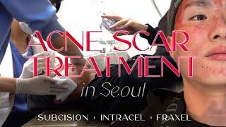  3 in 1 Acne Scar Treatment in Seoul  (+ Before & After)