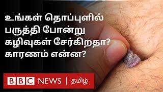 தொப்புள் குப்பை; உங்க தொப்புளில் திடீரென இப்படி  பஞ்சு போன்ற கழிவுகள் வர என்ன காரணம்? | Belly Button