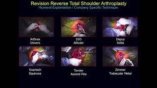 Sugical Techniques - Failed Reverse Total Shoulder Arthroplasty.