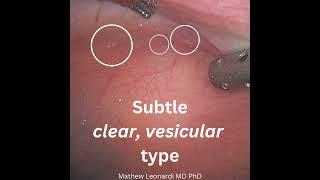 Can you spot the superficial endometriosis? #ultrasound #surgery #endometriosisdiagnosis