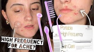 TESTING HIGH FREQUENCY ON ACNE FOR 2 WEEKS | Project E Beauty Argon High Frequency Skincare Device