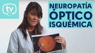 ¿Qué es la neuropatía óptico isquémica?