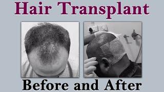 Hair Transplant Before and After || Dr. VJs Cosmetic Surgery & Hair Transplantation