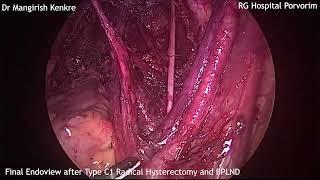 Retroperitoneal Clearance after Pelvic Lymphadenectomy