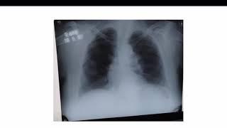 Chest X ray discussion - 2 Something is hidden!