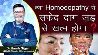 क्या homeopathy  से सफ़ेद दाग जड़ से ख़त्म होगा ? || can vitiligo be treated by homeopathy