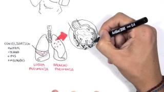 Pneumonia Overview