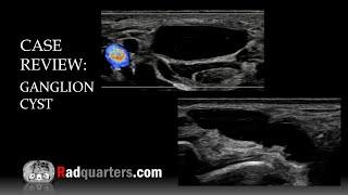 Ultrasound of Ganglion Cyst & Wrist Anatomy Review