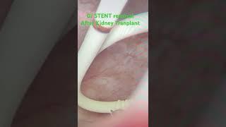 Inside operation- DJ stent removal after kidney transplant