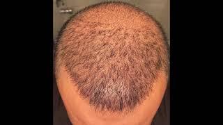 4300 Graft DHI Hair Transplant- day by day photo [1 month ]