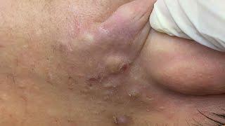 Acne Treament Under The Skin #061