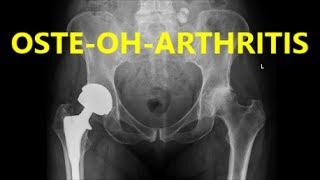 Dr Toney KISS Series: OSTEOARTHRITIS