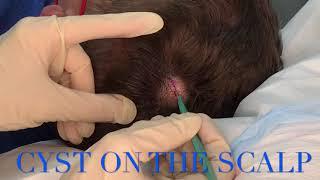 CYST ON THE SCALP AT COASTAL DERMATOLOGY AND MEDSPA