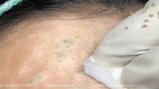 Big Cystic Acne Blackheads Extraction Blackheads & Milia, Whiteheads Removal Pimple Popping