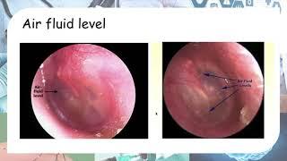 Acute otitis media - Otoscopy findings