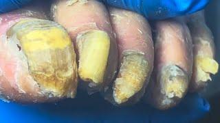 What A Long Yellow Onychomycosis, Like An Old Witch’S Long Nails【Pedicure Master Lin Jun】