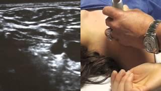 Ultrasound Guided Infraclavicular Nerve Block - SSRAUSA.com