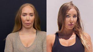 Woman Unhappy With Forehead Size Gets Reduction Surgery