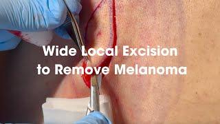 Wide Local Excision to Remove Melanoma