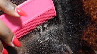 ITCHY DRY SCALP | SCRATCHING DANDRUFF | LICE COMB