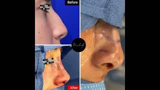 Rhinoplasty results with Dr. Boom Boom Pow 