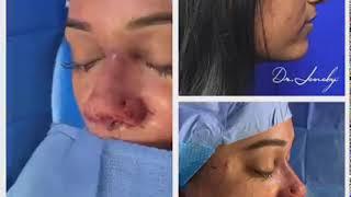 Rhinoplasty before and after results | Dr Jeneby Before and After Plastic surgery