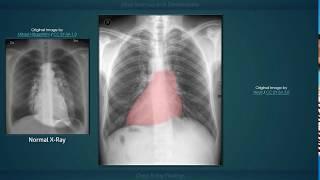Situs Inversus with Dextrocardia: Explanation of Chest X-ray Findings