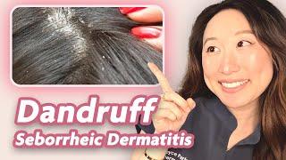 All about Dandruff & Seborrheic Dermatitis | Dermatologist Explains