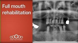 Full mouth rehabilitation - [Dr. Kim Yongjin]